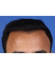 After Hair Transplant &nbsp;Front
